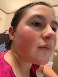 My son has always had red cheeks, which isn't common for someone with olive  skin tone. When he gets sun or sweats, they turn more red. These pictures  are of him naturally,
