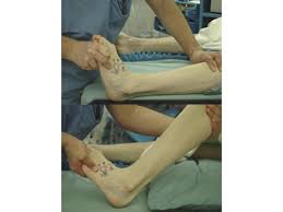 Image result for Wagner Ulcer Classification