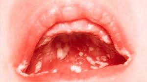 Finally, squeeze away the access water and place it on the area affected by the pimples. White Bumps On Lips Causes Treatments And More