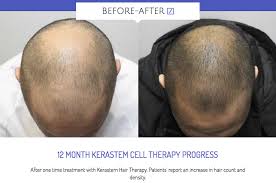 A treatment with hair stem cells is very beneficial to regenerate hair and stimulate its growth; New Kerastem Stem Cell Hair Loss Treatment Salon Prive Mag