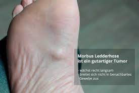 Morbus Ledderhose Ursachen Symptome Behandlung