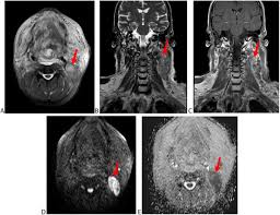 The increase of supraclavicular lymph nodes is the most common symptom in tumor processes in the chest and peritoneum. Lymph Nodes In The Head And Neck Cancer Would Diffusion Weighted Magnetic Resonance Imaging Solve The Diagnostic Dilemma Egyptian Journal Of Radiology And Nuclear Medicine Full Text