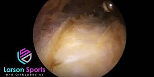 To view this video please enable javascript, and consider upgrading to a web browser that supports html5 video. The Real Cause Of Trochanteric Bursitis And What You Can Do About It Larson Sports And Orthopaedics