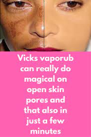 Vicks Vaporub Can Really Do Magical On Open Skin Pores And That Also In Just A Few Minutes Pores Are Small Openings O Skin Pores Oily Skin Remedy Vicks Vaporub