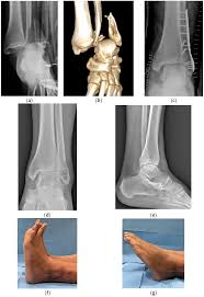 Image result for Ankle Dislocation