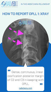 Xray filter photo scans tips and tricks online free guide. Opll Ossification Posterior Longitudinal Ligament X Ray Ct Mri Spine Online Radiology Course Radedasia