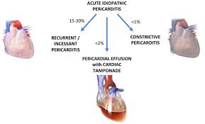 Image result for Post-MI Pericarditis