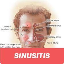 Sinusitis Types Causes Symptoms Complications Sinusitis Chronic Sinusitis Sinusitis Causes