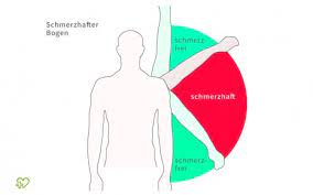 Impingement Syndrom Der Schulter Wie Wird Man Die Schmerzen Wieder Los Onmeda De