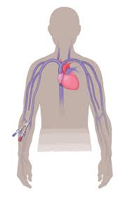 In order to help you do just that, here are five quick care tips to help you with your nasal cannula maintenance. Tubes Lines Ports And Catheters Used In Cancer Treatment