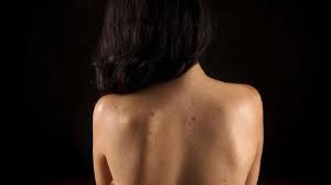 Meski begitu, jerawat di badan, terutama di punggung, menimbulkan rasa sakit yang sama. Cara Menghilangkan Bacne Jerawat Di Punggung