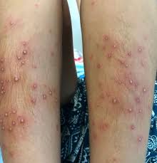 Image result for folliculitis symptoms