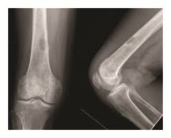 Image result for Osteomyelitis