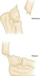 95% are extension type (foosh mechanism). Humerus And Elbow Clinical Gate