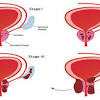 Prostate cancer can be deadly. 1