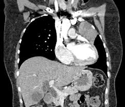 Carefirst of fort wayne, inc. Four Year Complete Remission In A Patient With Metastatic Epidermal Growth Factor Receptor Mutated Lung Cancer Treated With Two Cycles Of Erlotinib Journal Of Thoracic Oncology