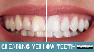 By removing plaque daily you are keeping your teeth & gums healthy. How Dentist Clean Yellow Teeth Princess Center Dentistry Scottsdale Az