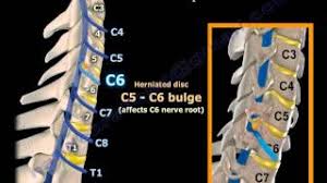 Menurutmu kamu masuk kedalam karakter yang mana? Neck Pain Disc Herniation Of The Cervical Spine Everything You Need To Know Dr Nabil Ebraheim Youtube