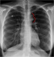 Figure 3 Sign A Chest Radiograph Sign Of Aortic Coarctation Where The Aortic Knuckle Has A 3 Shaped Left Sided Coarctation Of The Aorta Radiology Radiography