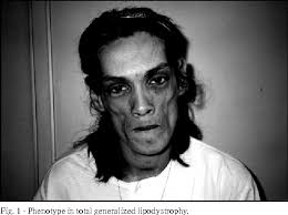 Inherited types affect babies and kids. Pdf Cardiac Involvement In Total Generalized Lipodystrophy Berardinelli Seip Syndrome Semantic Scholar