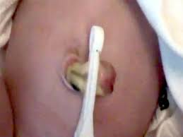 Wie Der Nabelschnurrest Verheilt Bilder Babycenter
