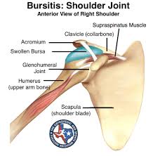 Usually bursitis is associated with tendinitis of the adjacent supraspinatus tendon. Bursitis Shoulder Joint
