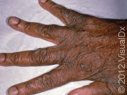 Image result for scabies on humans