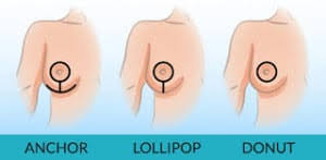 Depending on your unique needs and cosmetic goals, dr. Breast Lift Beware Of The Anchor Scars Barrett Plastic Surgery