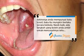 Pada masa ini kita merawat, melatih dan membentuk mental juara ayam bangkok. Kenali Batu Tonsil Mulut Dan Cara Untuk Hilangkannya