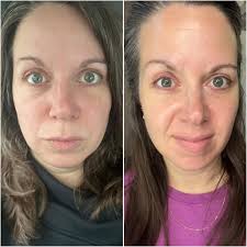 5 months to a new face with Pomifera products