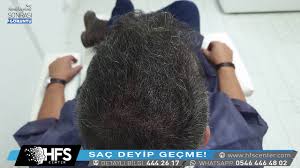 Sac Simulasyonu Bursa Hfs Center Youtube