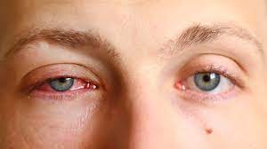 Keep Your Eyes Open For Pink Eye San Diego Sharp Health News