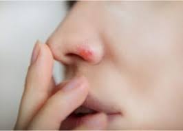 Small infections are common within the nasal vestibule that are usually caused by bacteria called staphylococcus. Why Does The Tip Of Nose Hurts When I Smile Ifpa Federation