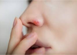 Nasal and sinus complaints are among the most common reasons for visits to primary care clinicians, otolaryngologists, and allergists. Why Does The Tip Of Nose Hurts When I Smile Ifpa Federation