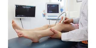 ¿qué es una trombosis venosa profunda? Diagnostico Y Tratamiento De Coagulos De Sangre Cdc