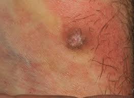 Hi, im in a simimilar situation but my symptoms were quick to develop. When To Suspect A Non Melanoma Skin Cancer The Bmj