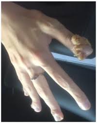 Recurrence in recalcitrant warts may be due to selective immunodeficiency or altered immune status in the patient. Medical Sciences Free Full Text Cimetidine A Safe Treatment Option For Cutaneous Warts In Pediatric Heart Transplant Recipients Html