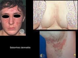 6. dermatitis and its variants