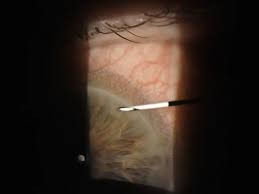 Image result for Conjunctival Foreign Body
