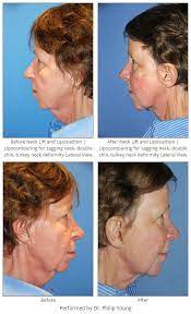 Before After Neck Lift And Liposuction Lipocontouring For Sagging Neck Double Chin Turkey Neck Deformity Lateral Vi Neck Lift Liposuction Plastic Surgery