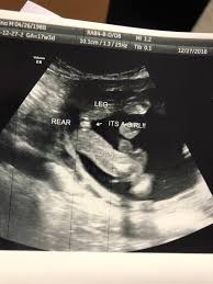 One of the most exciting times in the lives of parents is when they're expecting a child. Blood Test Said Boy Ultrasound Said Girl June 2019 Babies Forums What To Expect