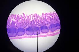 Image result for Intestinal Atresia