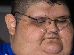 The first phase which began in 1635 and ended with the 1648 peace of westphalia is considered a related conflict of the thirty years' war. Obese Mexican Man Juan Pedro Franco Removed From Home The Advertiser