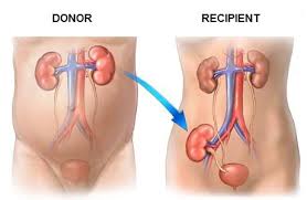 Image result for Transplantation