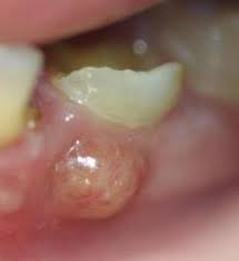 We did not find results for: Penyebab Gusi Bengkak Bernanah Karna Id