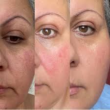 Why isn't your skin exfoliating with Pomifera?