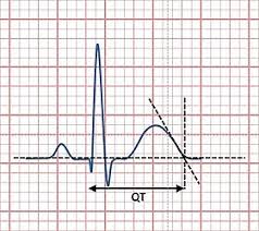 There are a variety of abnormal electrical rhythms, some are normal variants and some are potentially dangerous. Qt Interval Wikipedia