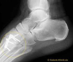 Fusswurzelarthrose Arthrose Des Lisfranc Gelenks Gelenk Klinik De