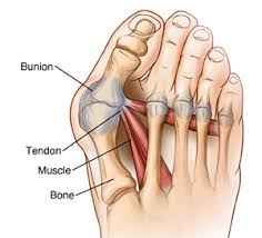 The ligaments of the foot help hold together the bones that support the arch. Osteotomy And Ligament Or Tendon Repair Bunion Surgery Saint Luke S Health System