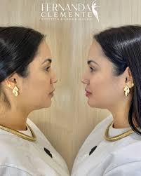 Rinomodelação: projeção, definição e harmonia